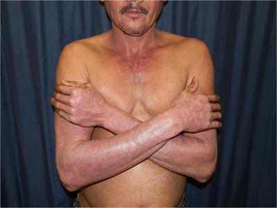HIV-associated photodermatitis in African populations
